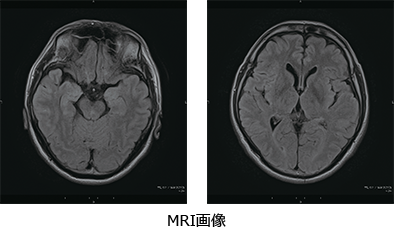MRI画像
